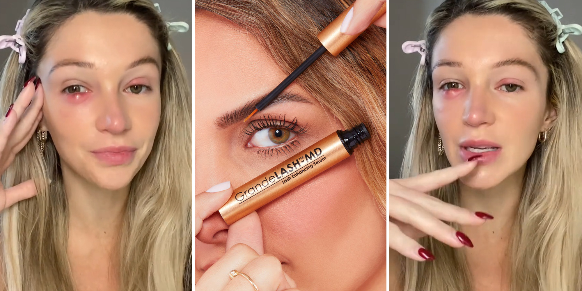 Customer shows how Grande Lash serum gave her severe reaction