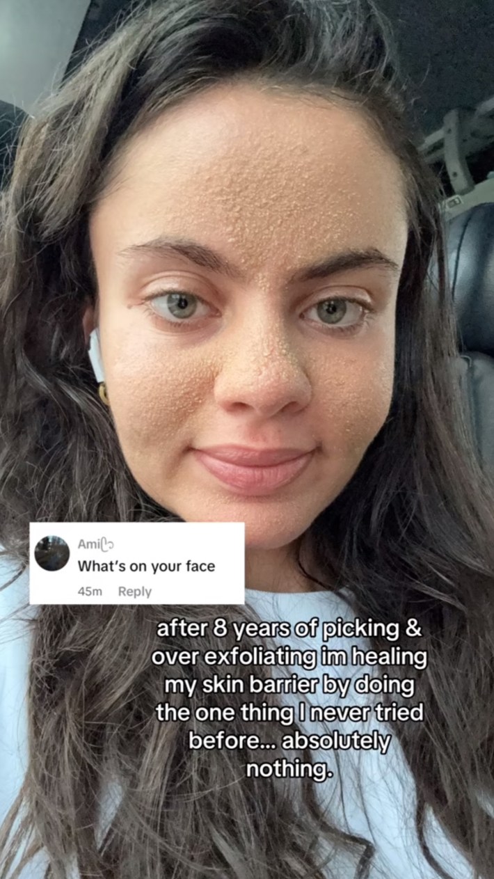 Woman with what looks like skin fungus on her face. Text overlay reads, "after 8 years of picking & over exfoliating I'm healing my skin barrier by doing the one thing I never tried before... absolutely nothing."
