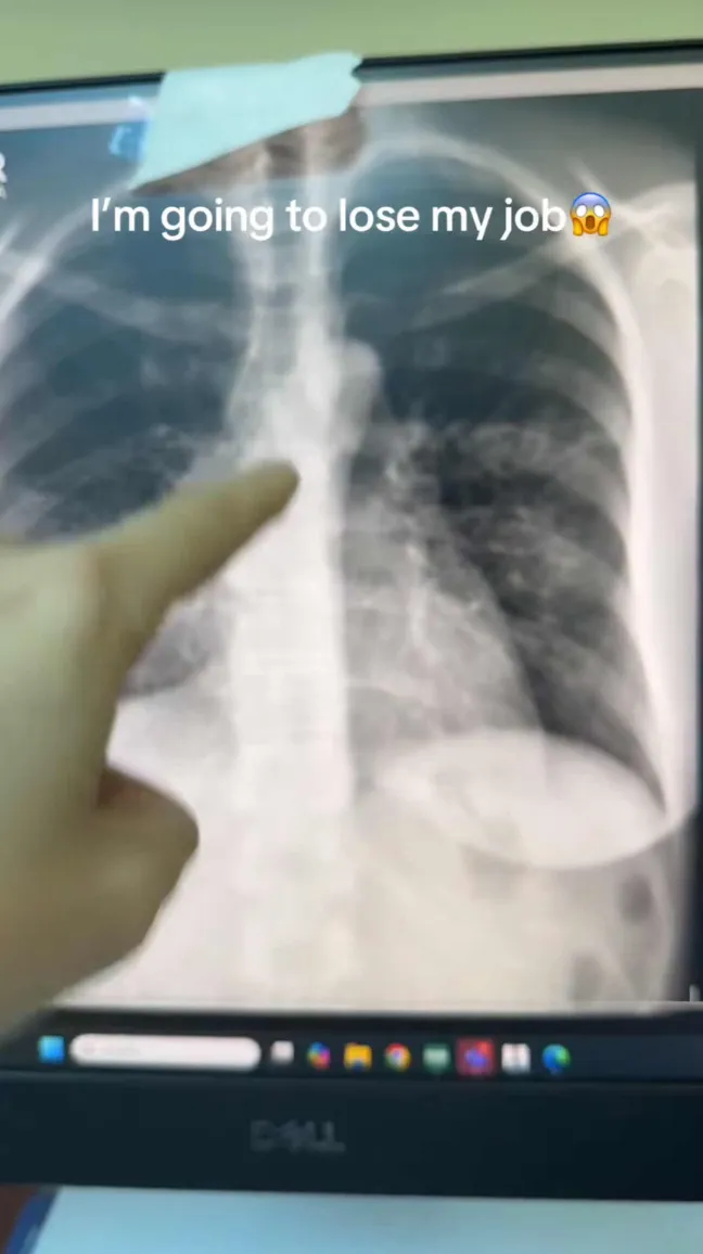 A pulmonologist pointing at a chest X-ray to show what he sees when he looks at it. Text overlay reads, "I'm going to lose my job (shocked face emoji)"