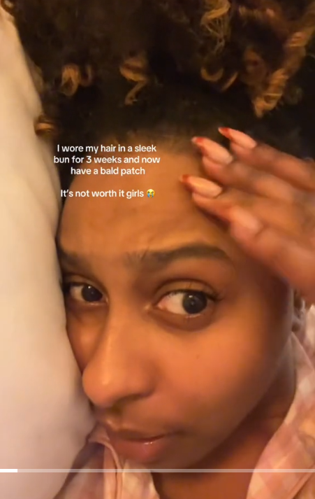Slicked back bun traction alopecia TikTok video with a woman touching her hairline.
