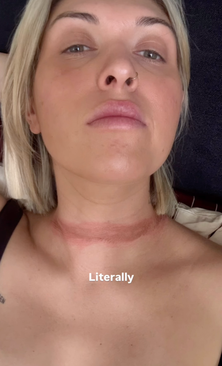 @eli__moulton/Instagram "literally" woman with burn ringing her neck