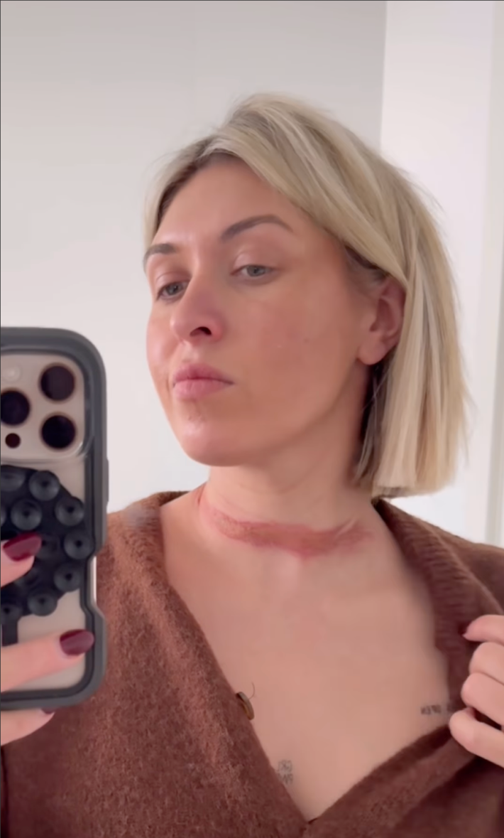 @eli__moulton/Instagram "literally" woman with burn ringing her neck