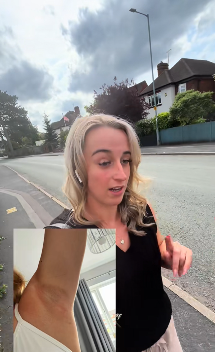 A woman walking along a street talking to her camera. A photo is on the screen showing her under arm rash.