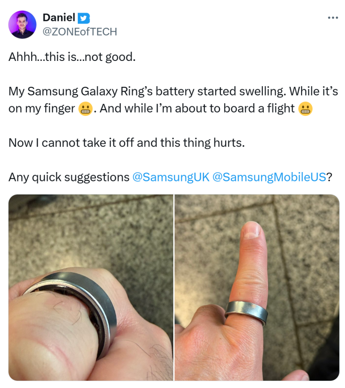 Daniel's Samsung ring swelling and the photos of it on his finger, cutting off circulation.