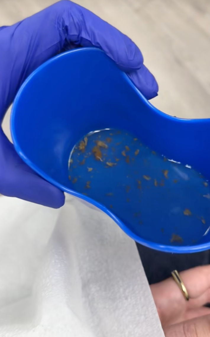 @javirod305 /TikTok heving earwax removal service at CVS MinuteClinic - healthcare provider shows chunks of wax removed from patient's ear