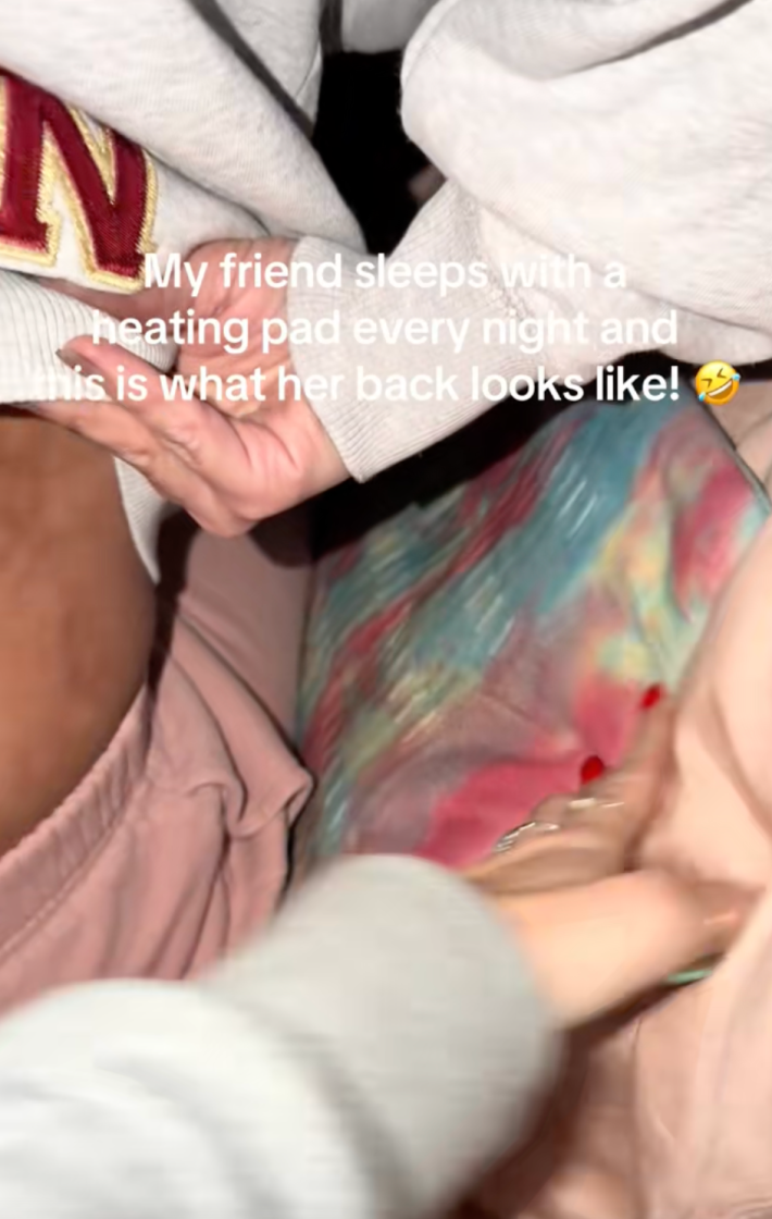 The video's onscreen text read, "My friend sleeps with a heating pad every night and this is what her back looks like." @teezubal revealed the telltale fishnet patterned rash covering her friend’s back