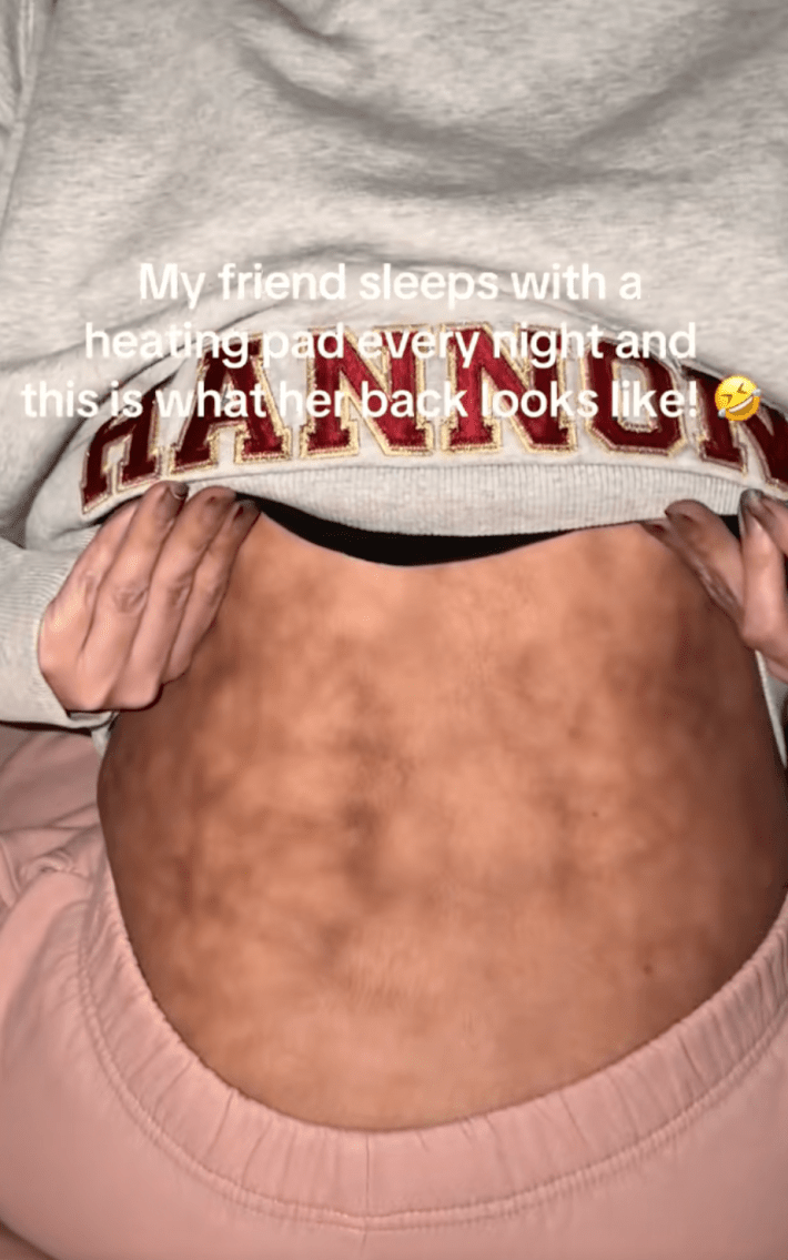 The video's onscreen text read, "My friend sleeps with a heating pad every night and this is what her back looks like." @teezubal revealed the telltale fishnet patterned rash covering her friend’s back