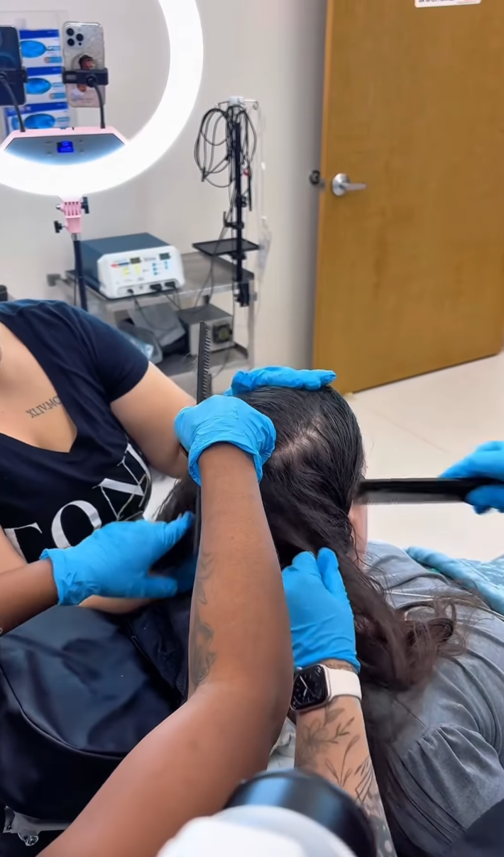 @ledafazal/Instagram team of hair stylists performing sedated hair dematting