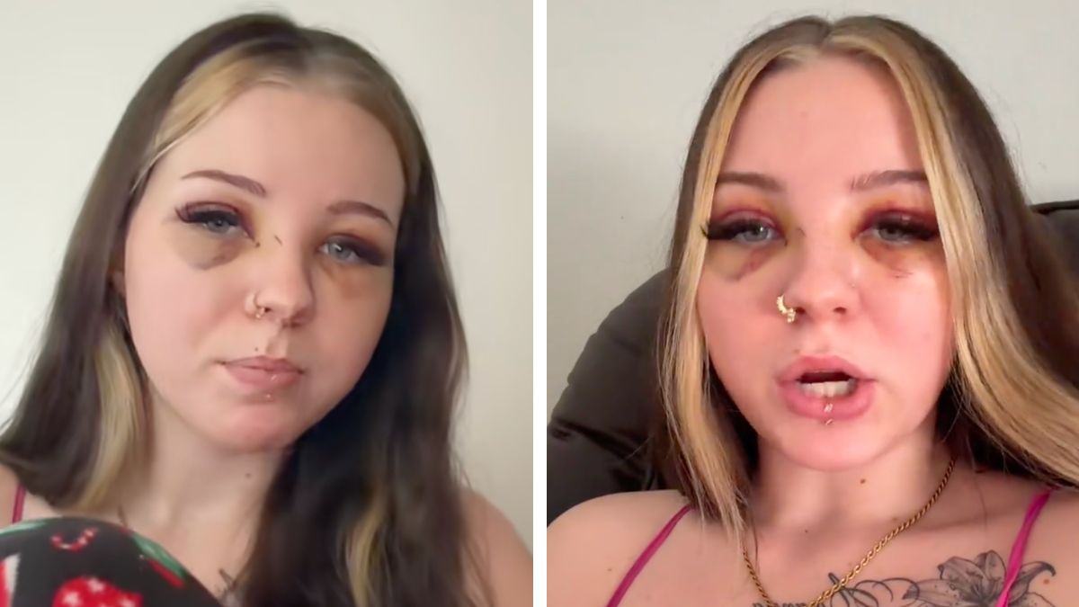 TikToker revealed how a 'fake friend' caused her two black eyes.