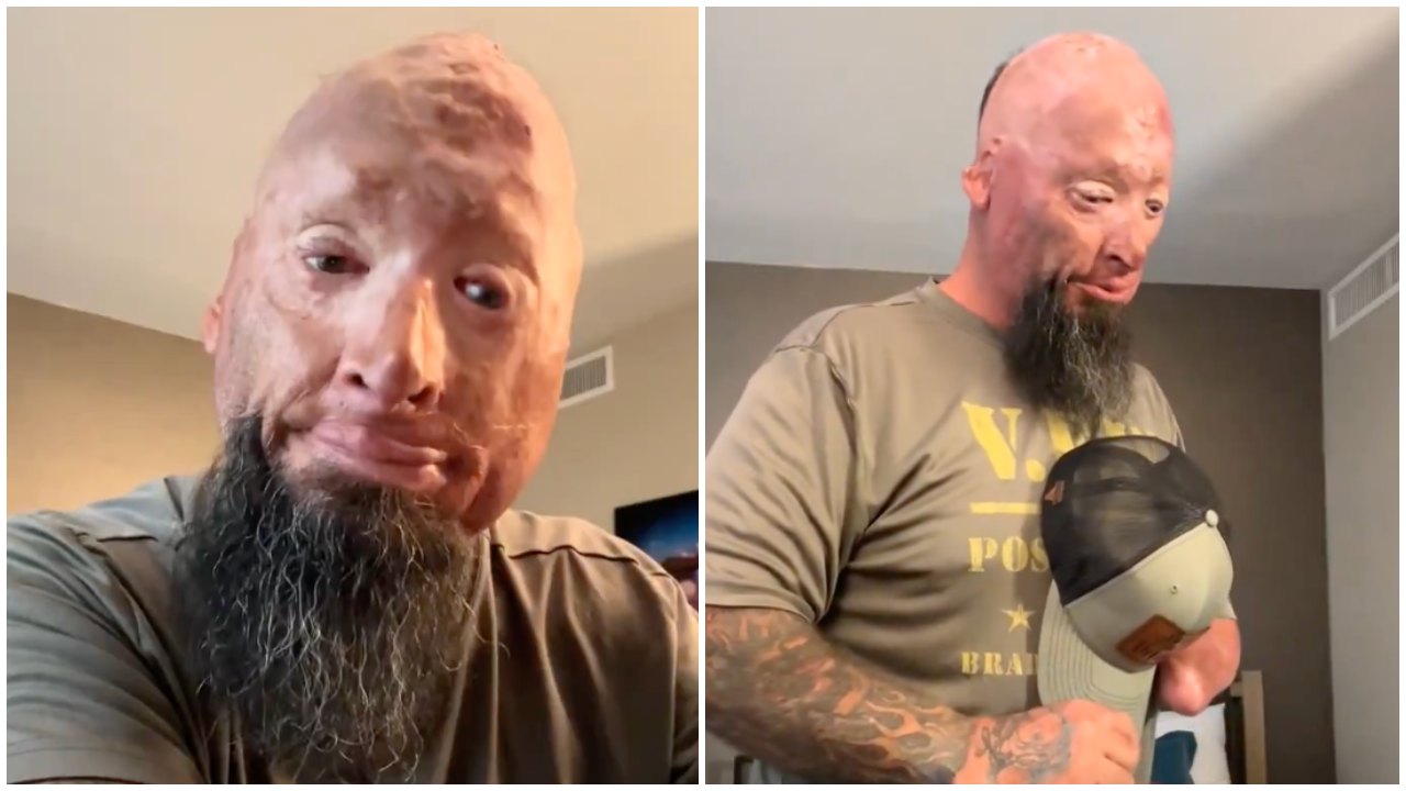 Burned Veteran Calls Out Girls’ Behavior at Airport