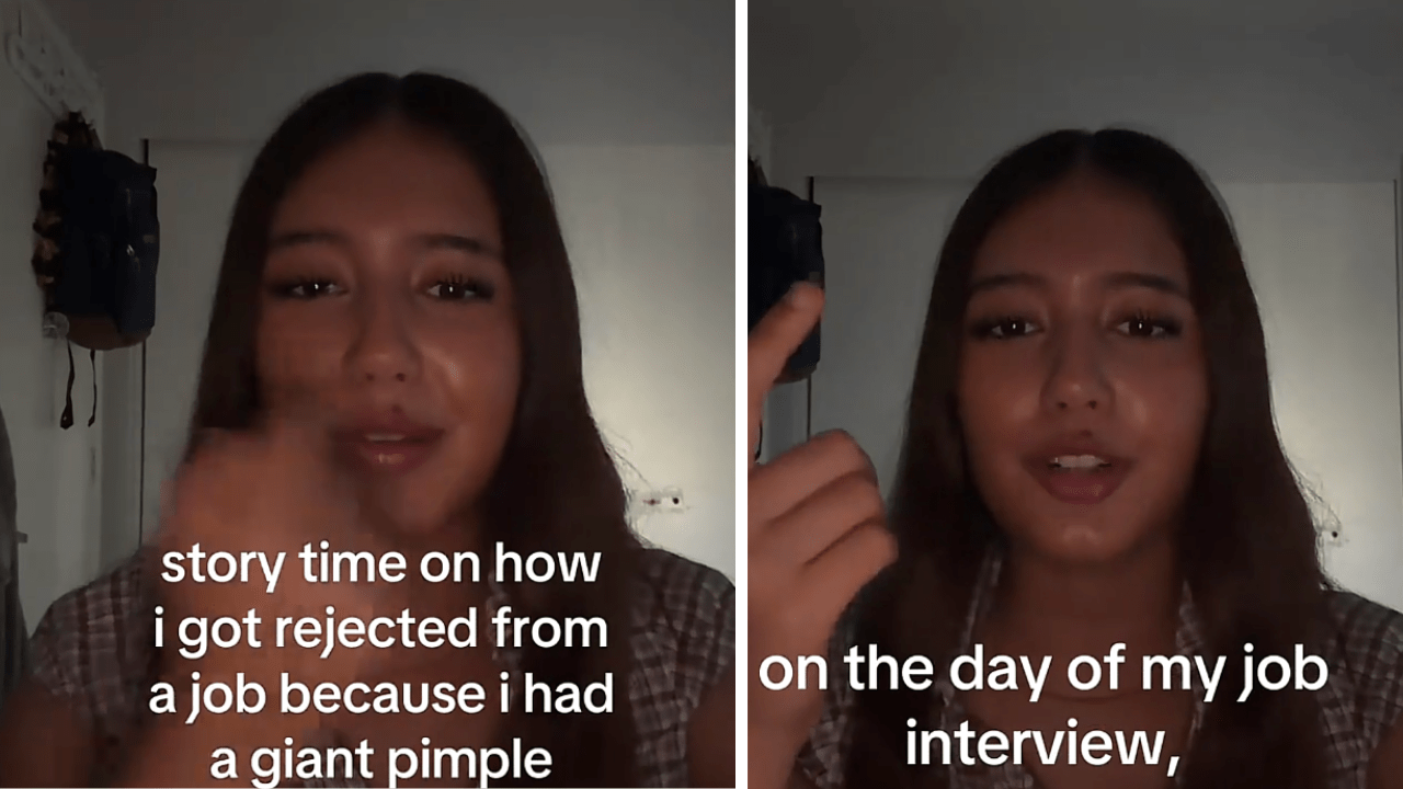 Woman Says She Was Rejected for a Job Over a Pimple
